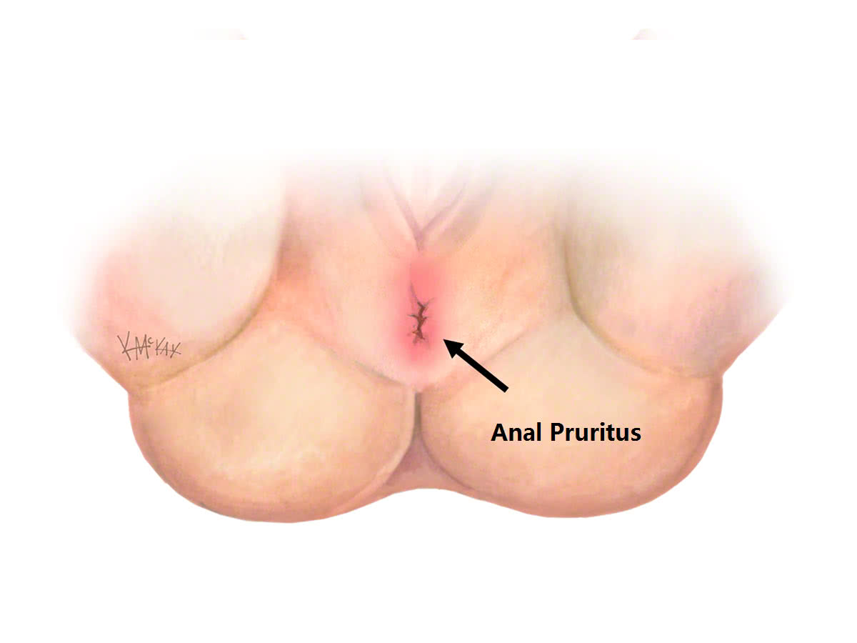 Anus fungal infection