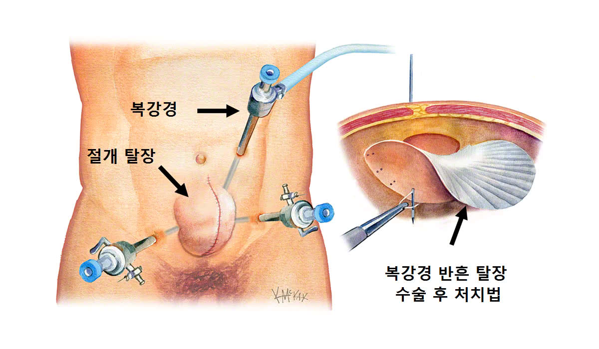 절개탈장 수리 대장 외과 의사 시드니