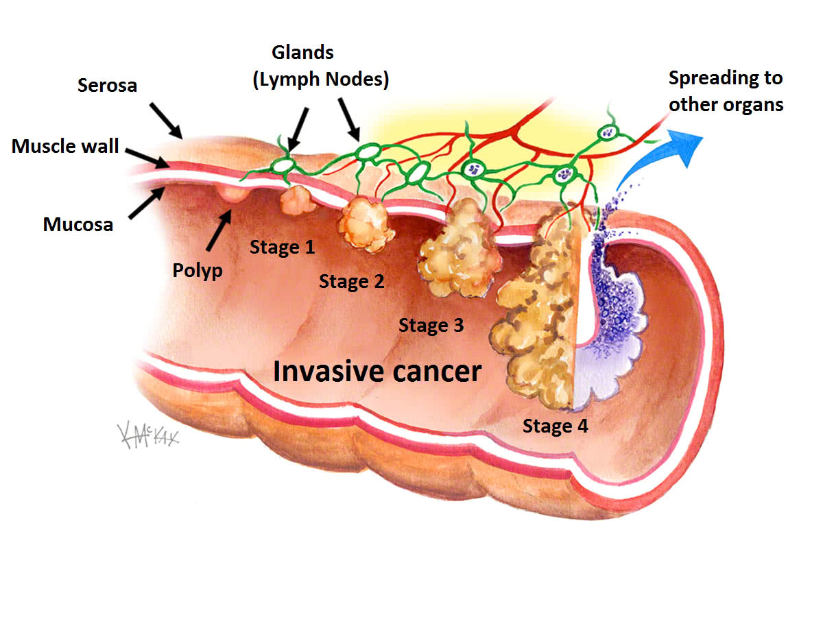 familial-adenomatous-polyposis-symptoms-treatment