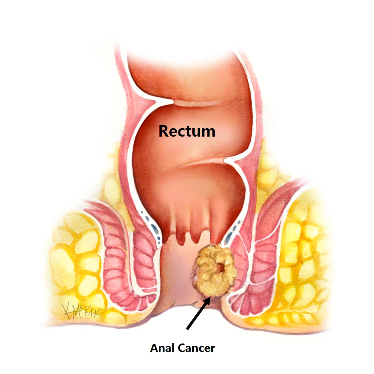 Anal Cancer | Colorectal Surgeons Sydney