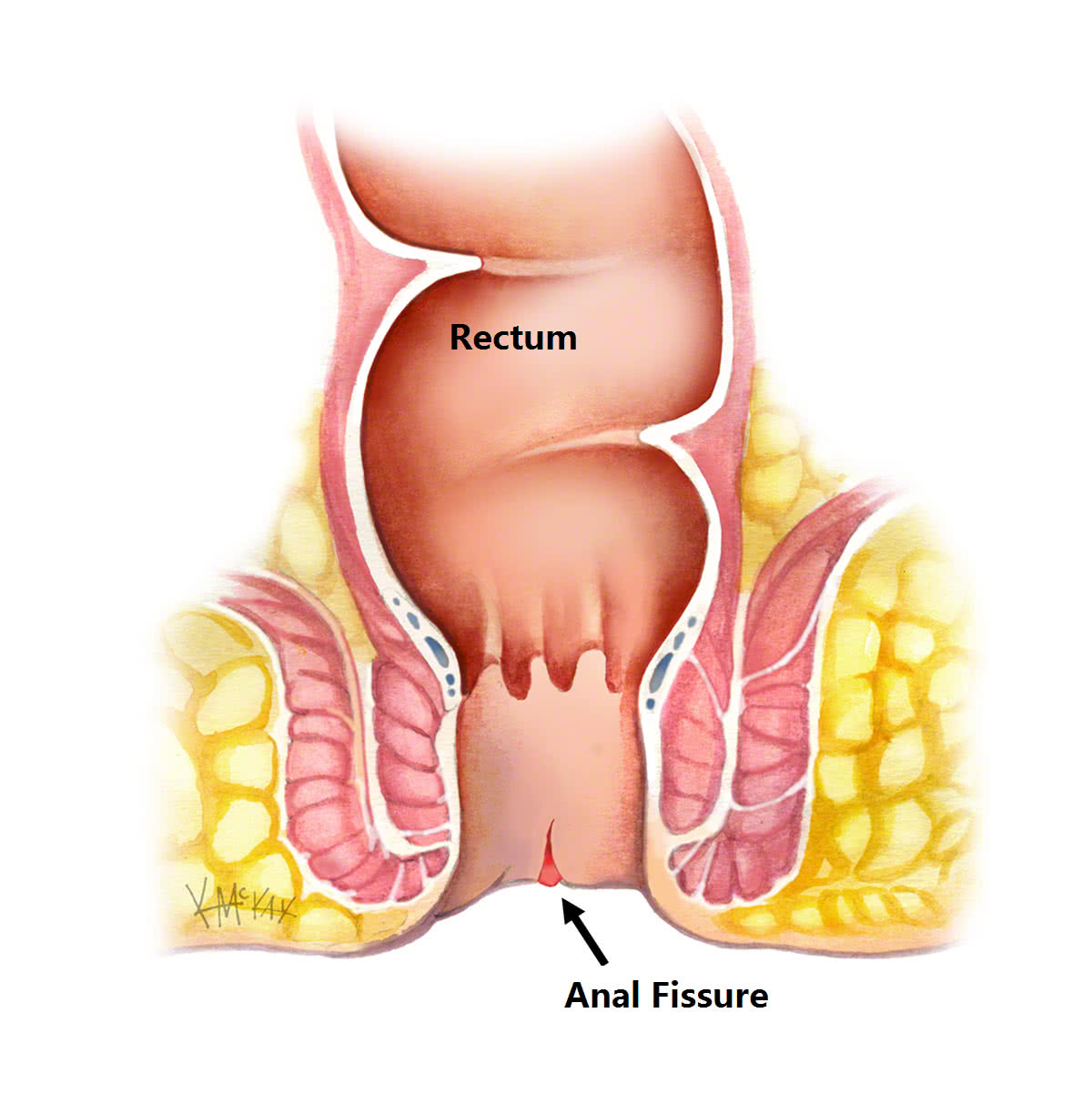 Anal treatment procedure