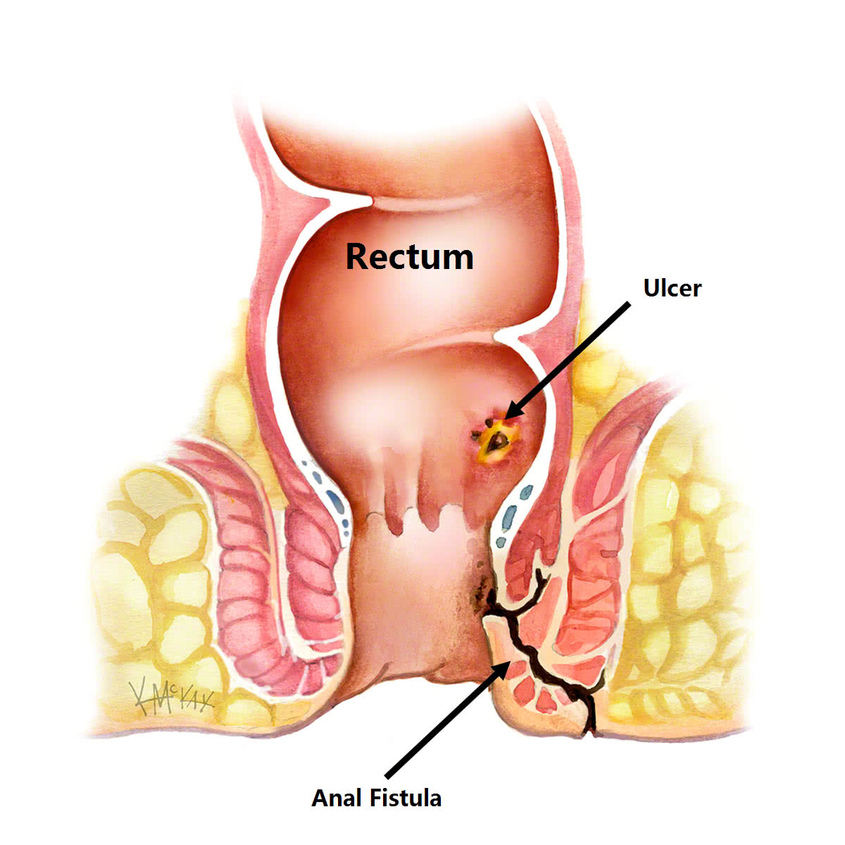 anal fistula surgery