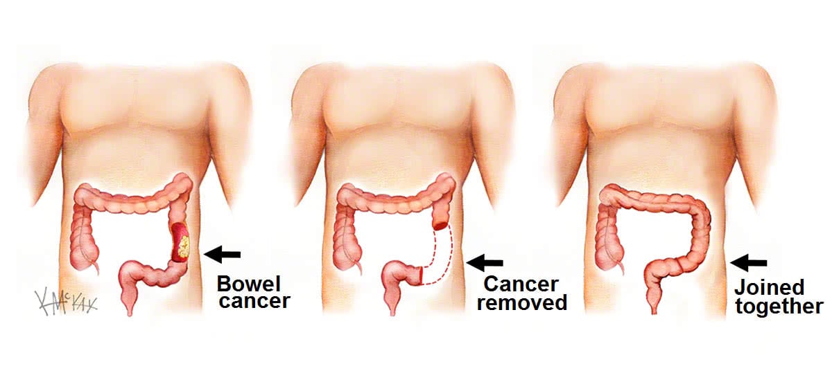 Treatments - Surgery - Digestive Cancers Europe