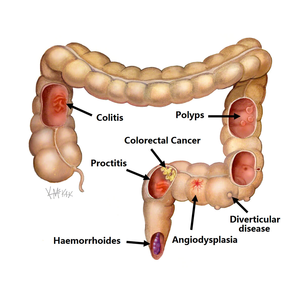 Rectal Bleeding  Colorectal Surgeons Sydney