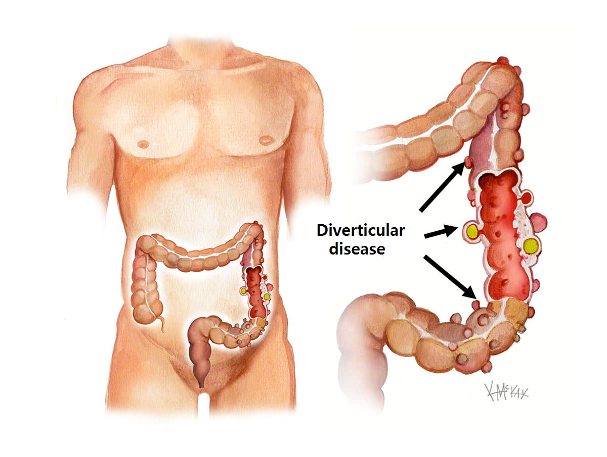 Diverticulos en el colon imagenes