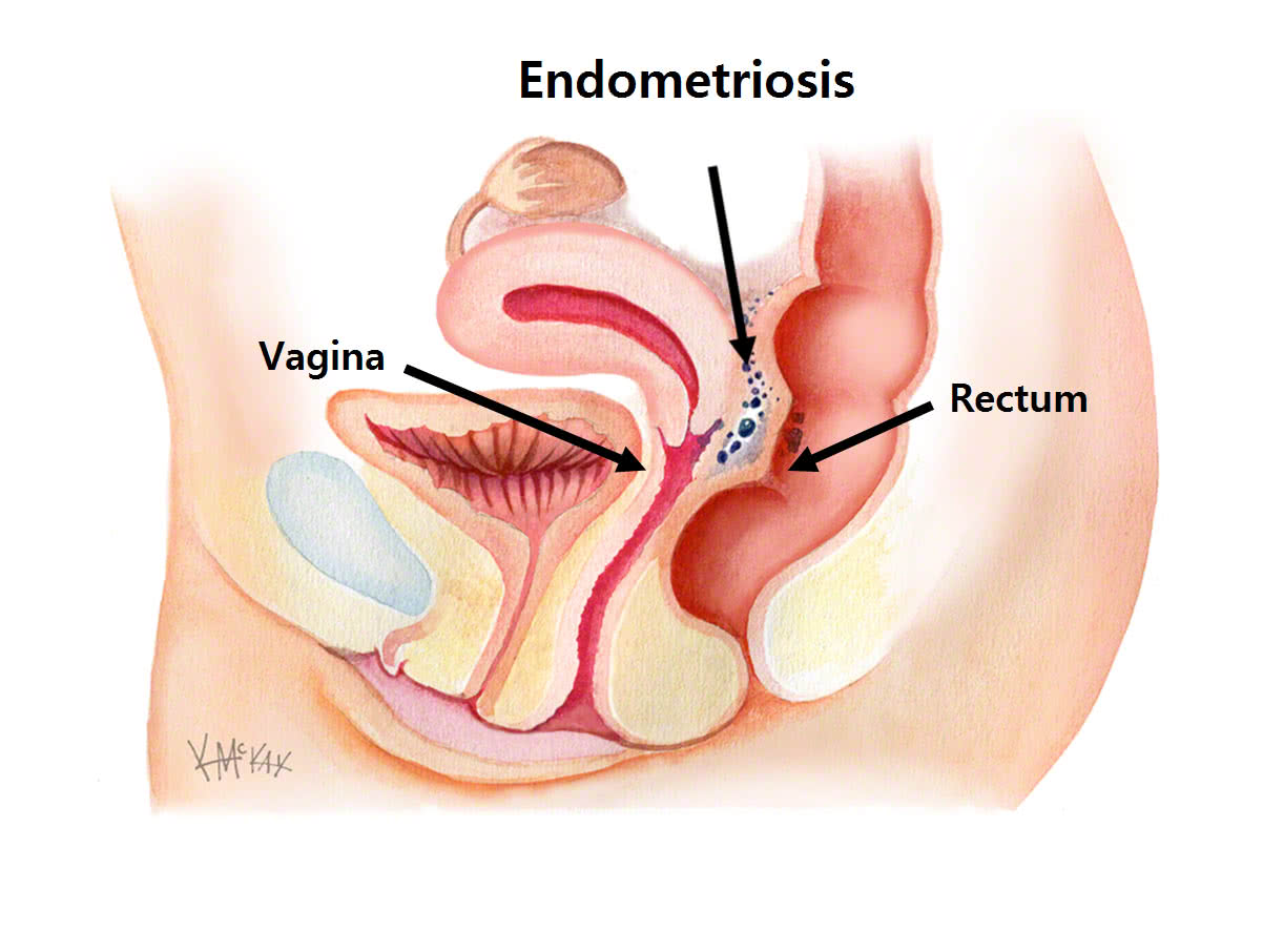 Endometriosis  Colorectal Surgeons Sydney