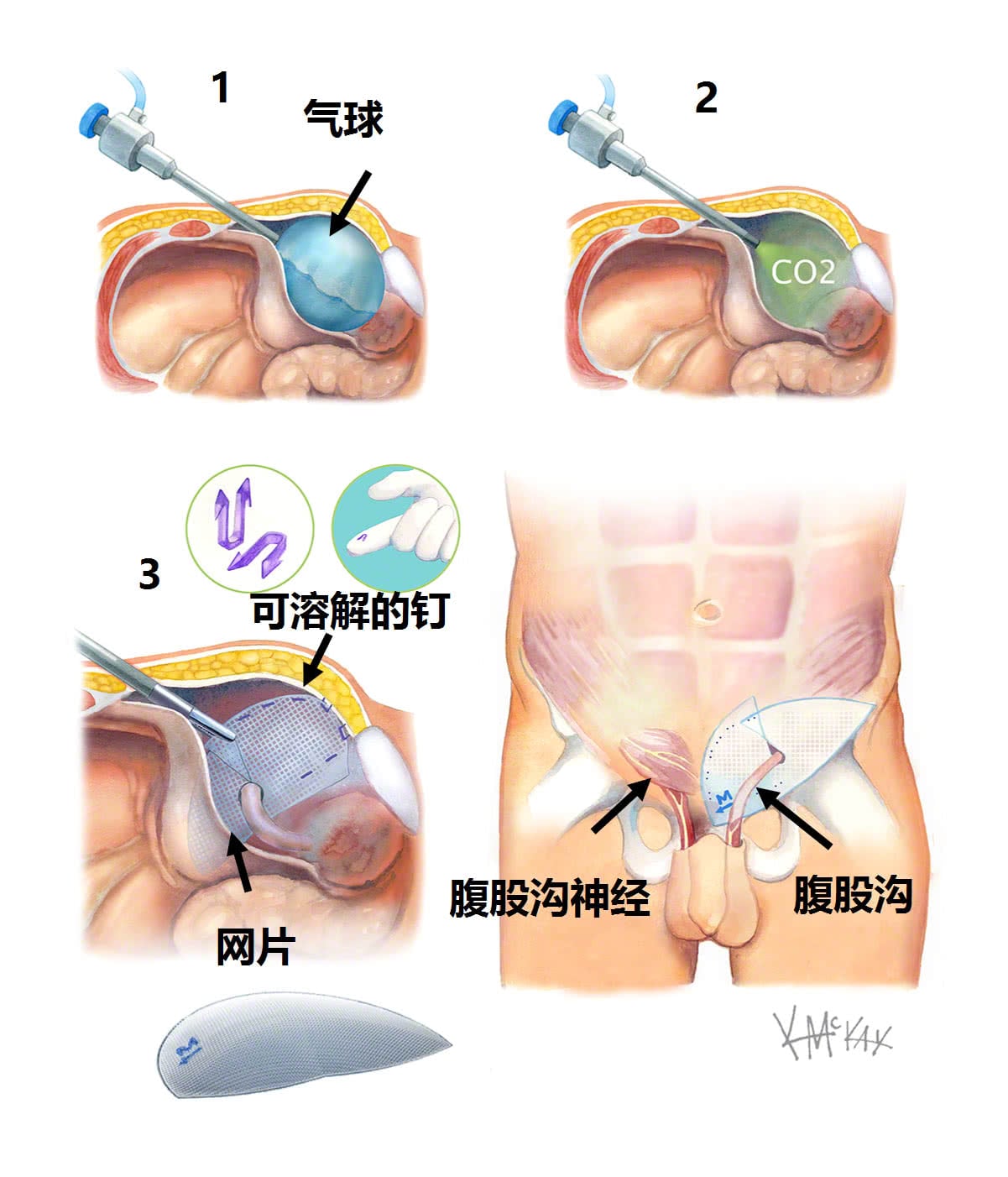 腹股沟疝氣修复 悉尼大肠外科医生