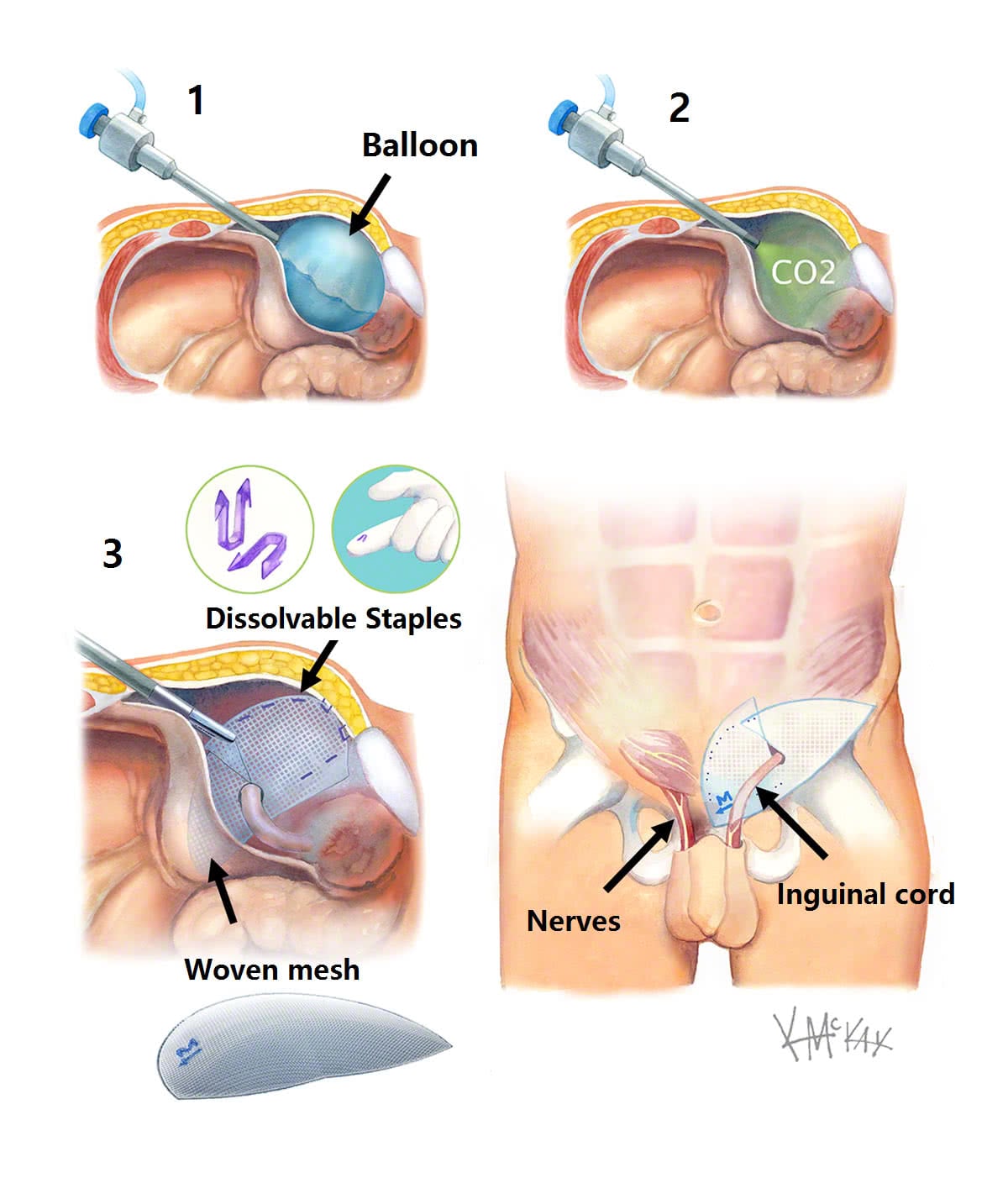 Department Of Surgery Inguinal Hernia