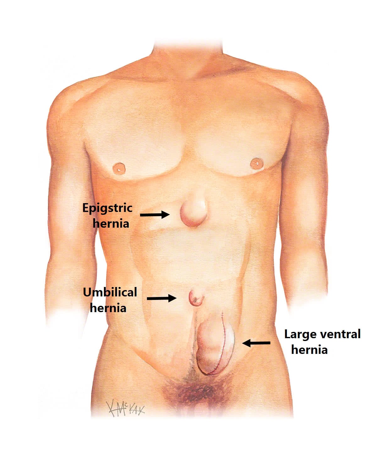 Cureus, Component Separation: A Case Report of Hybrid and Synthetic  Absorbable Mesh Use for Complex Large Ventral Hernia Reparation