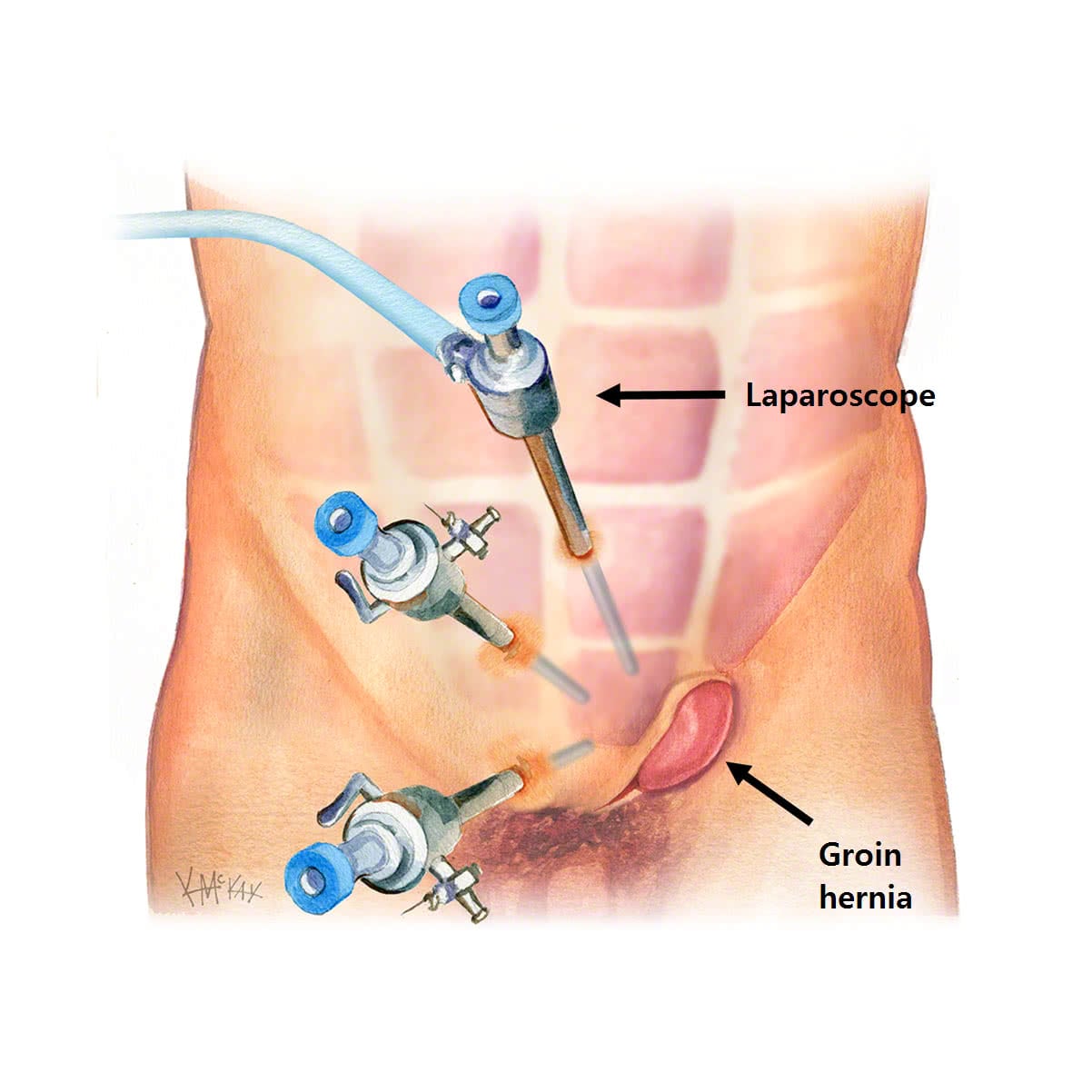 Keyhole Surgery for Inguinal & Femoral Hernia in Adult Melbourne