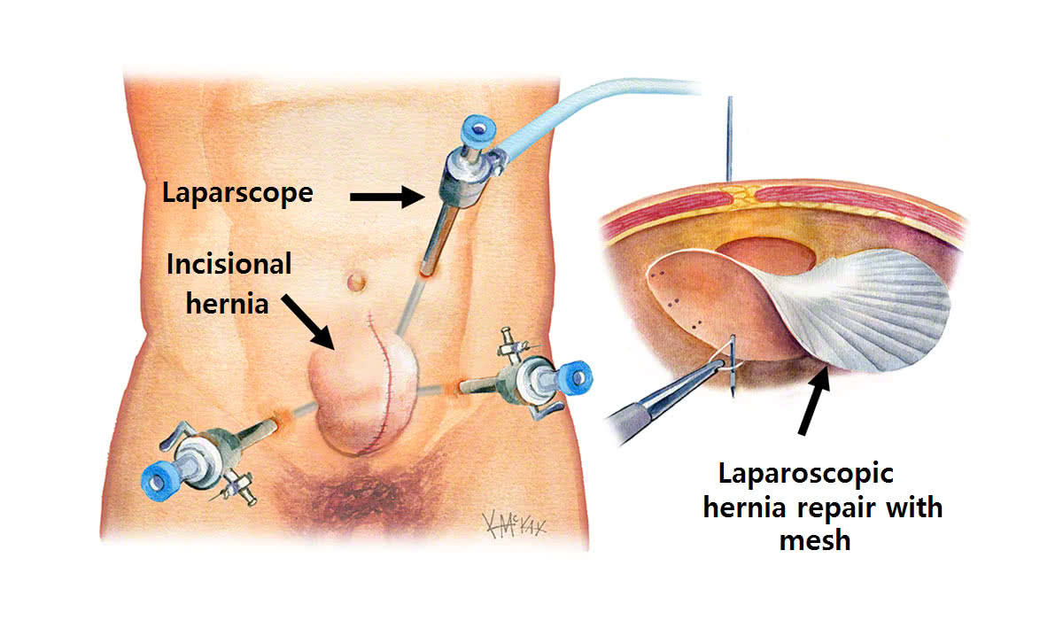 Incisional Hernia Repair  Colorectal Surgeons Sydney