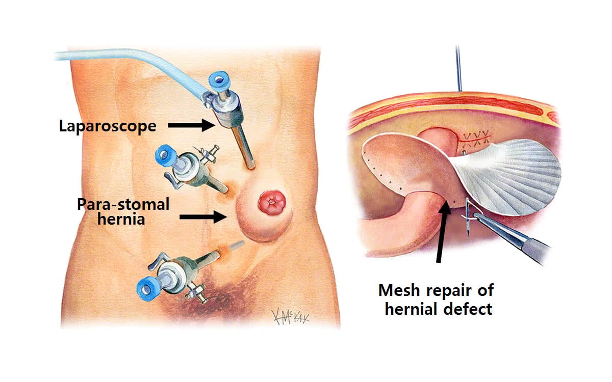 Stoma Hernia Repair  Colorectal Surgeons Sydney