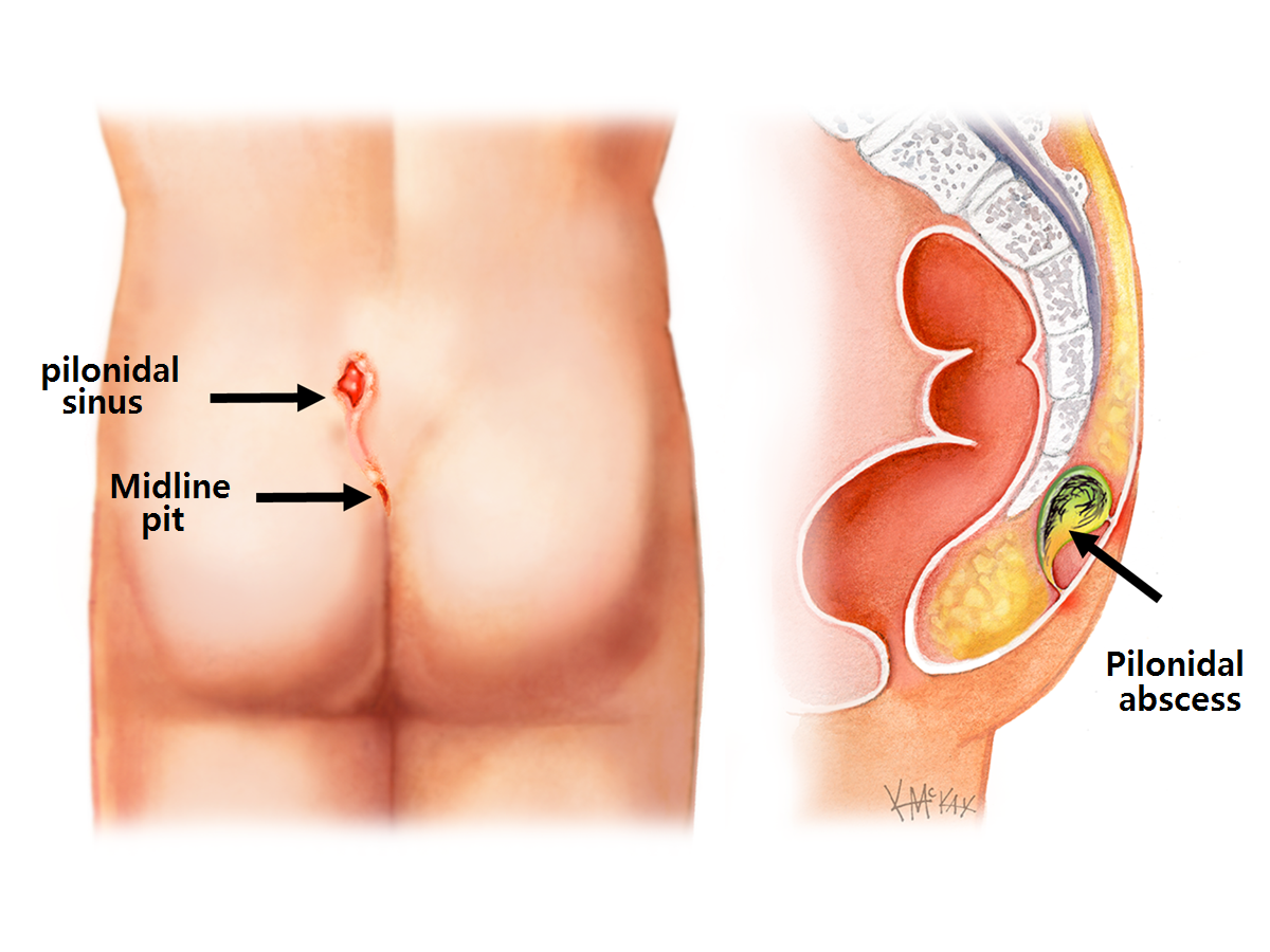 Pilonidal Sinus and Pilonidal Cyst