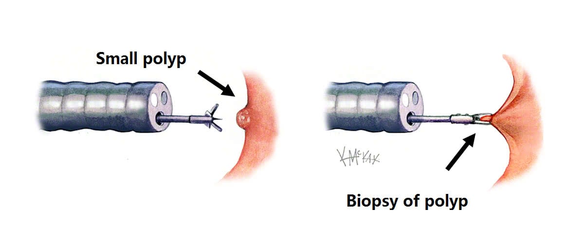 Биопсия желудка. Колоноскопия полипэктомия. Щипцовая полипэктомия что такое.