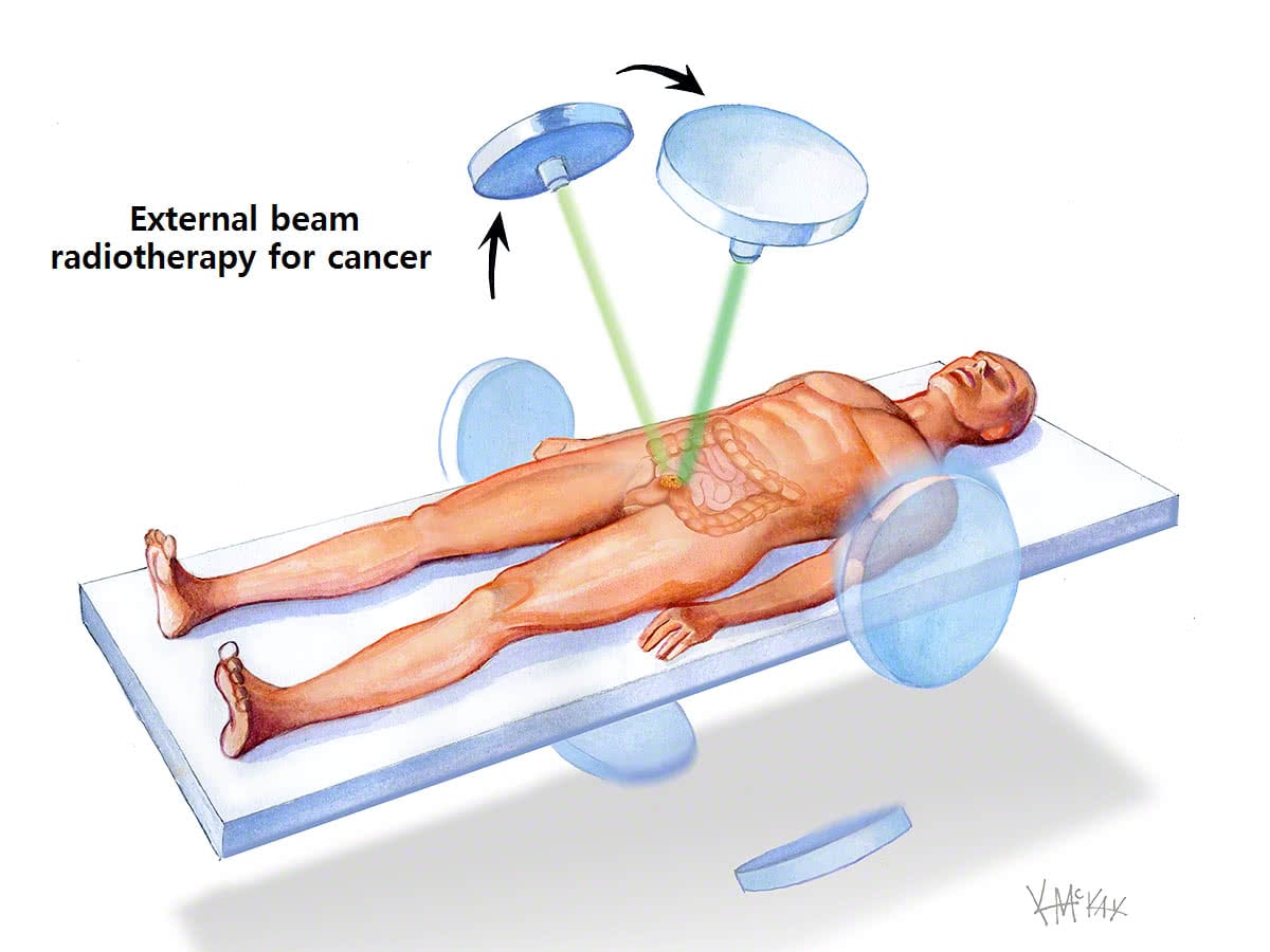 Como se hace la radioterapia