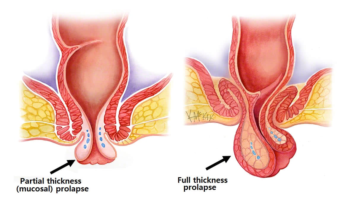 Rectal Prolapse Colorectal Surgeons Sydney