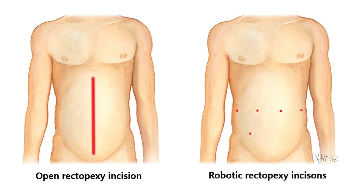 Rectal Prolapse Colorectal Surgeons Sydney