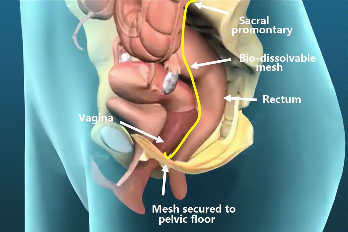 Rectal Prolapse | Colorectal Surgeons Sydney