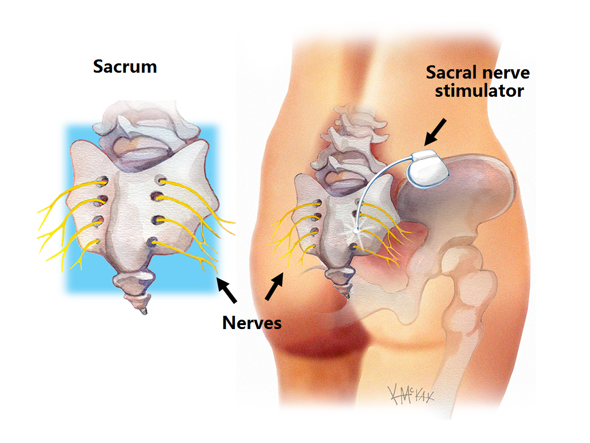 Discover the solutions and treatments for faecal incontinence with -  Ostocare