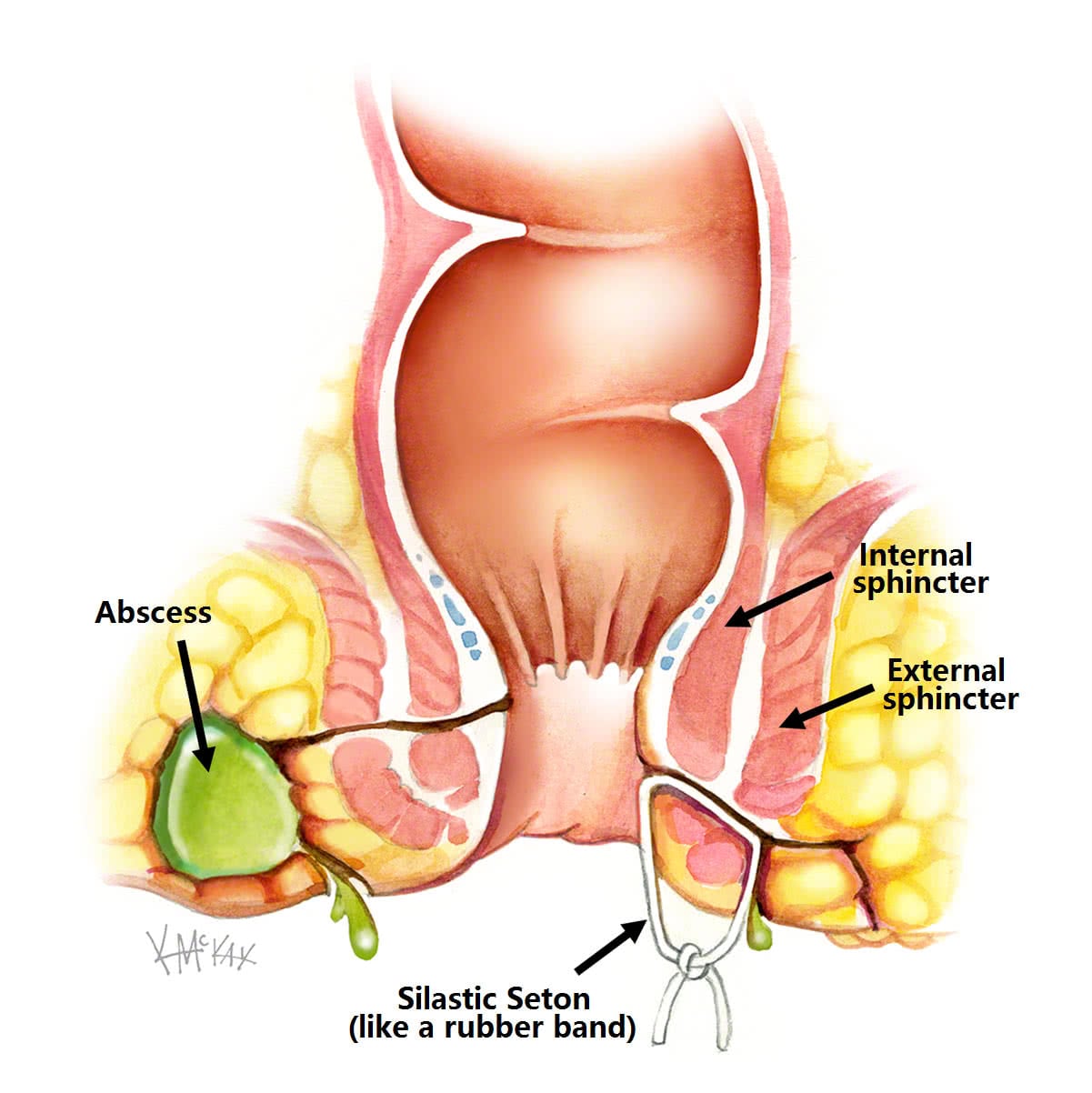 Anal fistula plug sedation