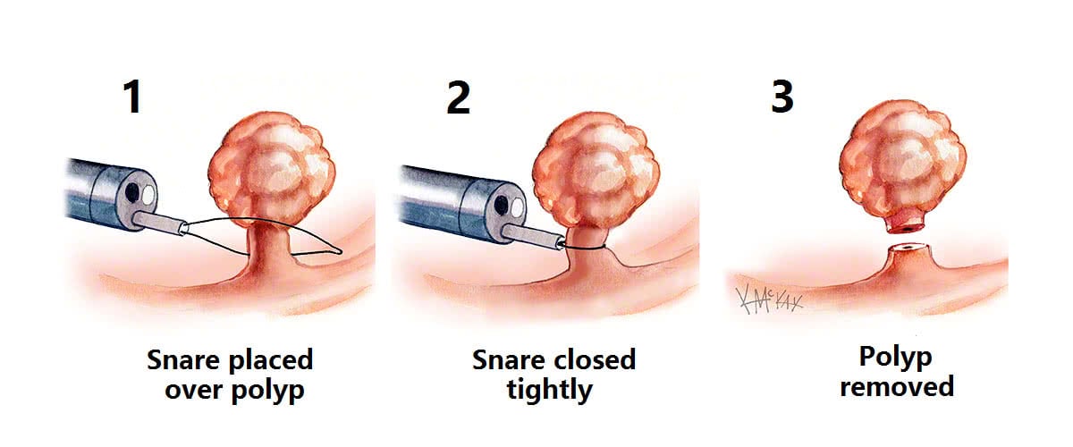 surgical removal of colon polyps