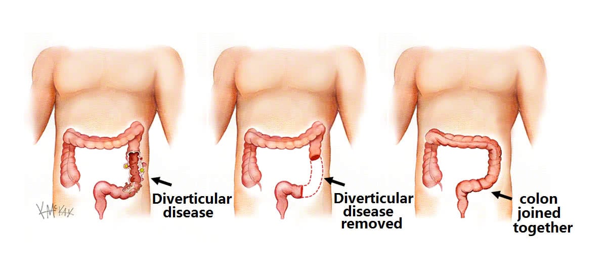 Diverticular Disease Colorectal Surgeons Sydney 6698